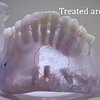opti-clear_125_-_jaw.jpg